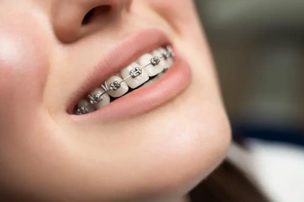 Aparat dentar fix metalic