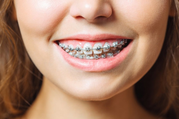 Aparat autoligaturant (self-ligating)